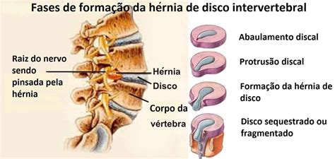 Abaulamento Discais Difusos L4 L5 E L5 S1 RETOEDU