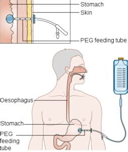 Percutaneous Endoscopic Gastrostomy Peg Tube Mediliv Hospital Nashik