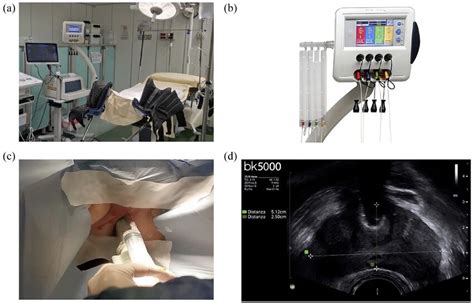 A Intraoperative Setting B Laser Setting Screen C Transrectal Download Scientific