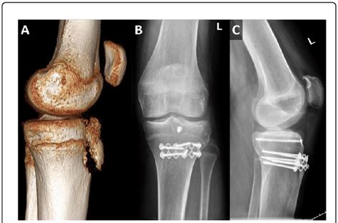 Tibial Tuberosity Pediatric X Ray