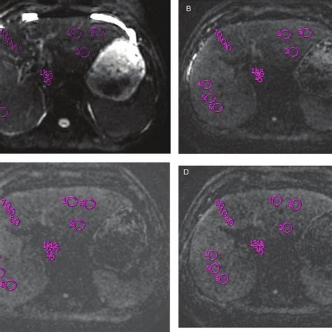 In A 47 Year Old Male With Childpugh Class C Liver Cirrhosis Three