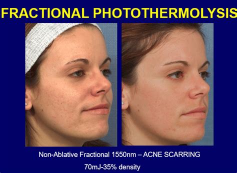 Fraxel Laser Skin Resurfacing New York Ny Laser Center