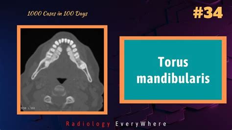 Torus Mandibularis Explained