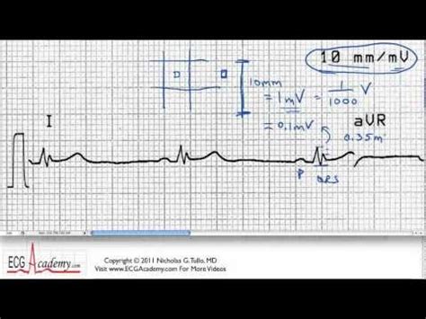 Interpretacja Ekg Okre Lanie Skali Czasowej Film Medtube Pl