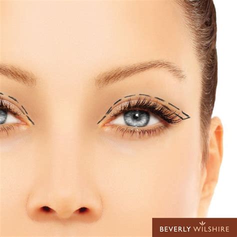 Double Eyelid Surgery 6 Things You Should Know Beverly Wilshire Medical