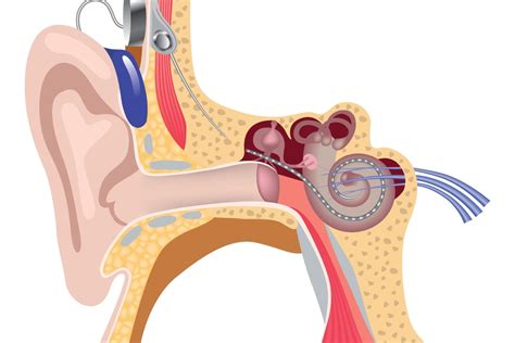 Koklear İmplant Biyonik Kulak Nedir ve Nasıl Çalışır Güven Hastanesi