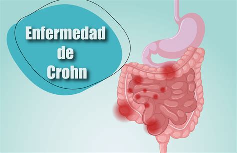 ENFERMEDAD DE CROHN Instituto de Salud Digestiva y Hepática