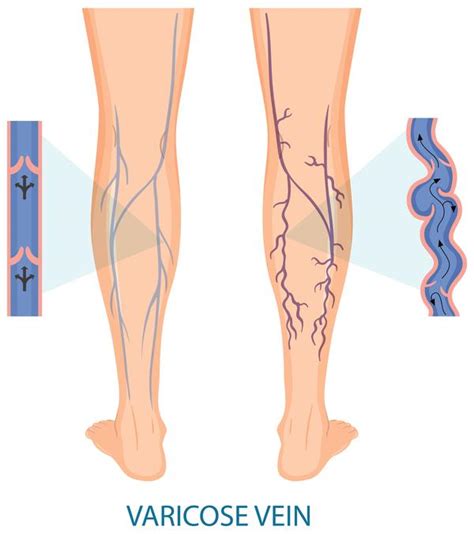 Varicose Spider Veins Causes Treatement And Prevention Women Yarabel