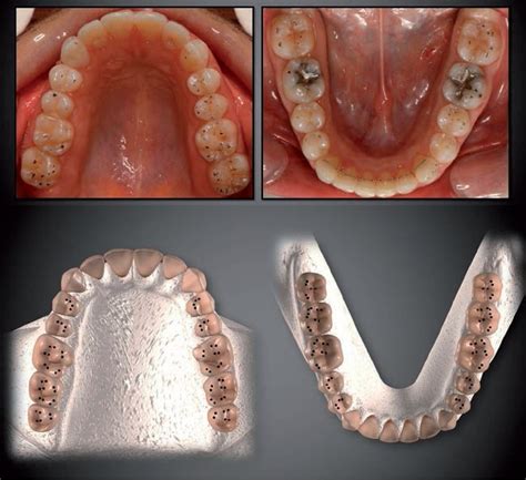 El Ajuste Oclusal Preventivo En Los Tratamientos Dentales