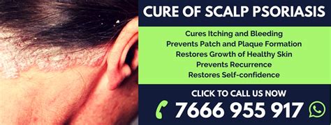 How to Cure Scalp Psoriasis Permanently [Rapid Relief] | LIVE POSITIVE