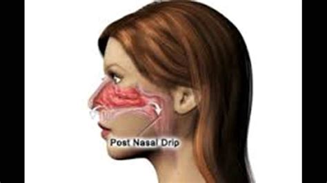 Post Nasal Drip In One Nostril