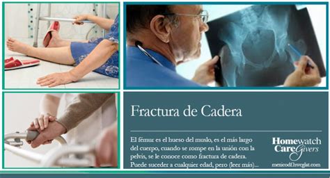 Fractura De Cadera Causas S Ntomas Y Tratamiento