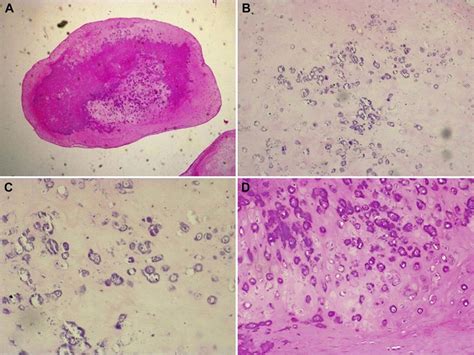 Histopathologic Examination Shows The Cartilage Nodules That May Be