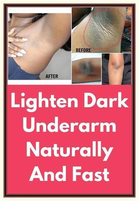 How To Whiten Underarms Fast And Naturally Poils Ind Sirables Beaut