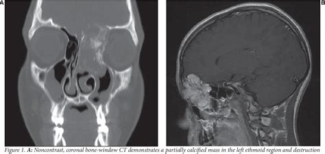 Figure 1 from Osteosarcoma of the Skull Base in a 15-year-Old Boy ...