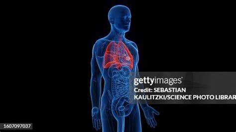 Lung Cancer Illustration High-Res Vector Graphic - Getty Images