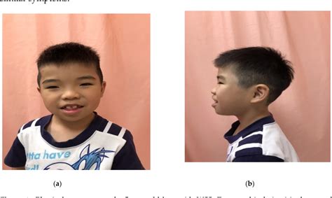 Figure 1 From Wiedemannsteiner Syndrome With A Pathogenic Variant In