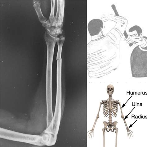Osso Da Ulna 5
