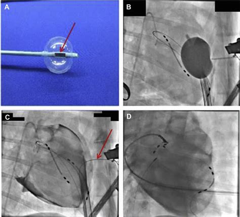 The Future Of Percutaneous Epicardial Interventions Cardiac