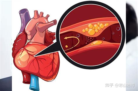 急性胸痛怎么办？如何迅速判断？急性冠脉综合征（acs）的判断和预后 知乎