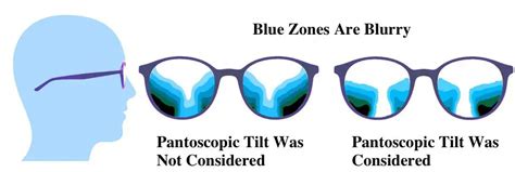 When Pantoscopic Tilt Was Not Considered In Progressive Glasses 1