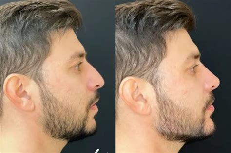 Ex Bbb Caio Afiune Faz Harmoniza O Facial Veja Antes E Depois