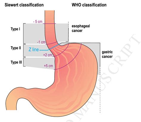 PDF The Surgical Management Of Esophago Gastric Junctional Cancer