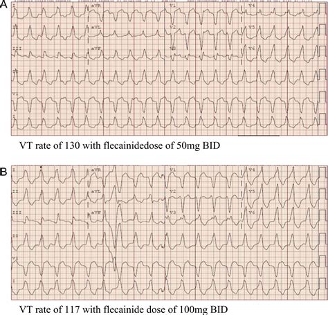 Use Of Flecainide In Combination Antiarrhythmic Therapy In Patients With Arrhythmogenic Right