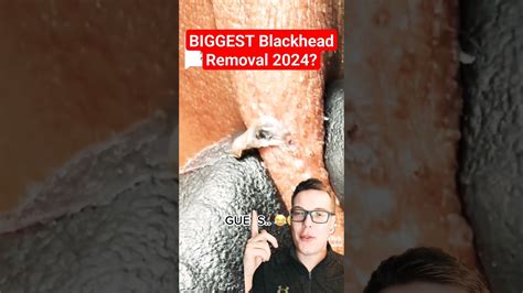 Unbelievable Blackhead Removal 2024: The Ultimate At-Home Guide - v7peubq