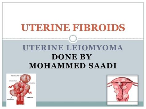 Uterine Fibroid Leiomyoma And New Treatment Modalities