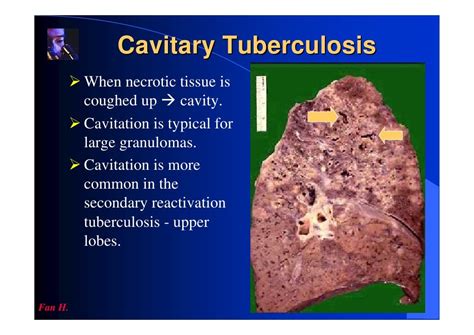 Pulmonary Tuberculosis