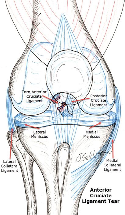 Anterior Cruciate Ligament Tear Sports Medicine And Orthopedics