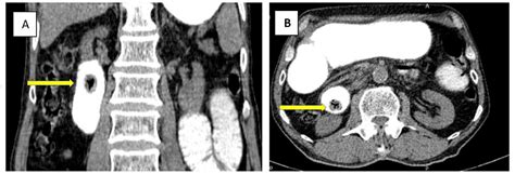 Cureus The Diagnosis And Management Of Recurrent Gallstone Ileus A