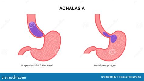 Esophageal Achalasia Disease Cartoon Vector CartoonDealer 287086683