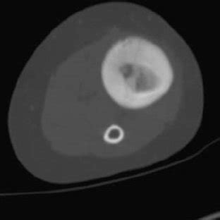 Preoperative Sagittal CT Scan Image Depicting The Nidus CT Scan