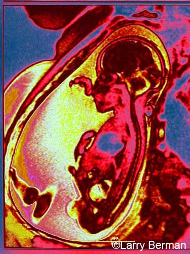 Fetal MRI