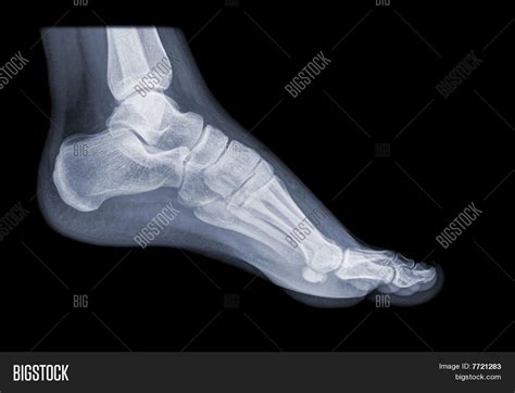 Healthy Foot On X-ray Image & Photo | Bigstock