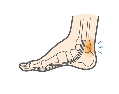 Posterior Ankle Impingement