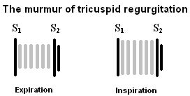 Tricuspid Valve Regurgitation | LearntheHeart.com