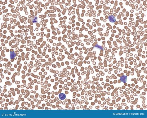 Diffuse Large B-cell Lymphoma in Perpheral Blood. Stock Image - Image ...