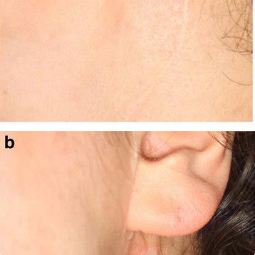 Example Of The Blair Incision The Patient Received Parotidectomy With