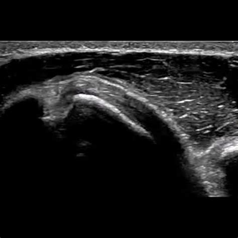 Shoulder Anatomy Shoulder Ultrasound