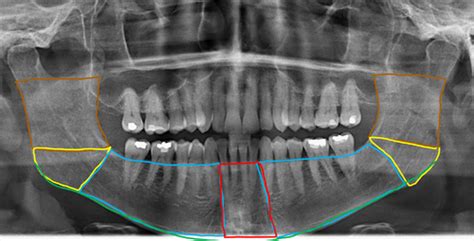 Panoramic Radiograph Anatomy Flashcards Quizlet