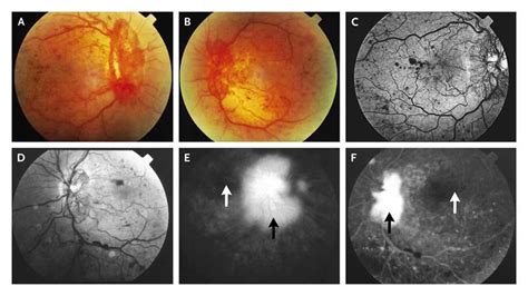 Severe Nonproliferative Diabetic Retinopathy