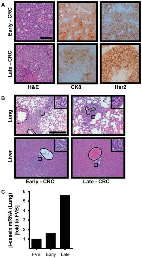 A H E And Immunohistochemical Staining Of Ck And Her In Early P