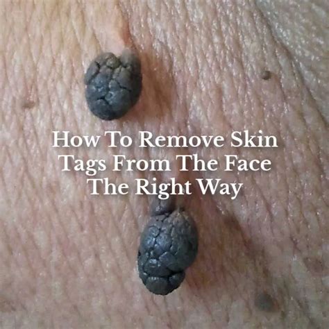 How To Remove Skin Tags From The Face Sharpologist, 46% OFF