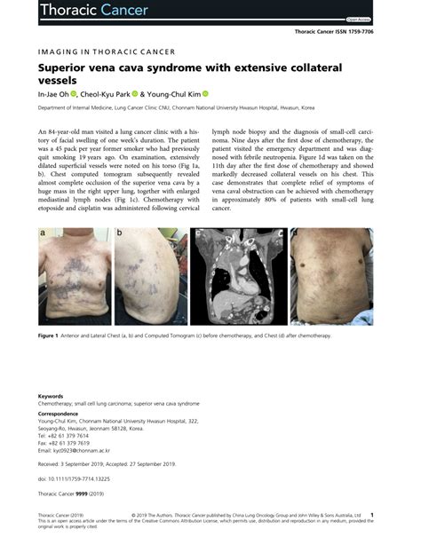 Pdf Superior Vena Cava Syndrome With Extensive Collateral Vessels