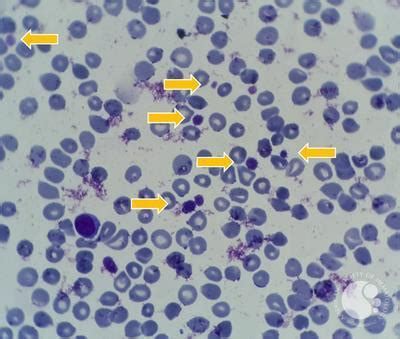 Giant Platelet in a Patient with Thrombocytosis