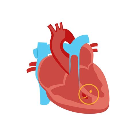 Congenital Heart Defect, Cardiovascular Disease Illustration Icon