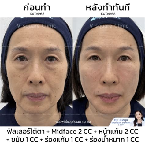 face lifting methods  firm youthful tight skin